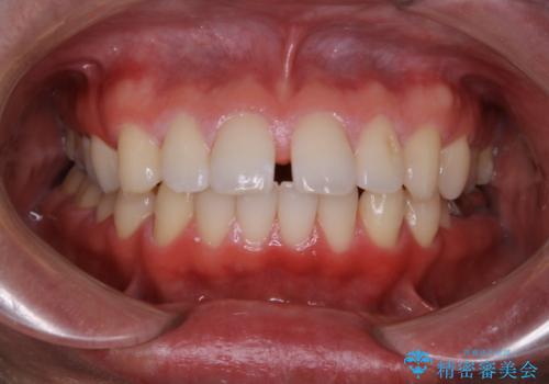 インビザライン・ライトで”すきっ歯と出っ歯”を改善の症例 治療前