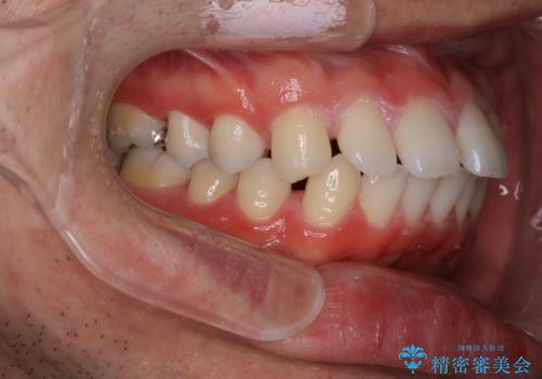 インビザライン・ライトで”すきっ歯と出っ歯”を改善の治療前