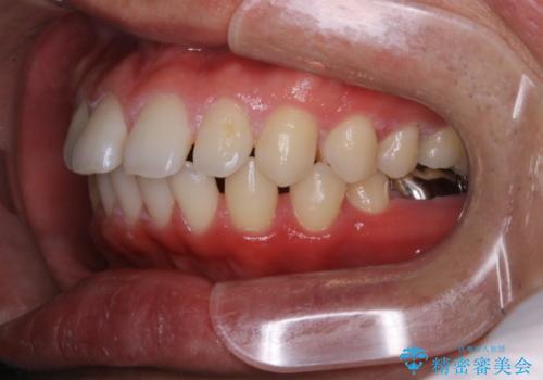 インビザライン・ライトで”すきっ歯と出っ歯”を改善の治療前