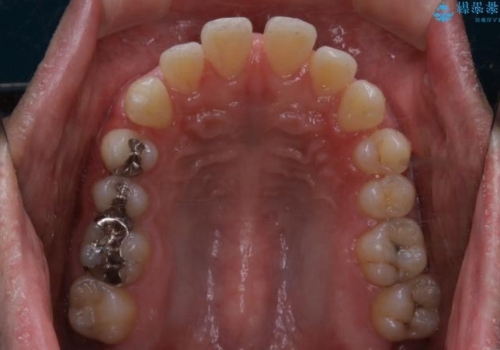 インビザライン・ライトで”すきっ歯と出っ歯”を改善の治療前