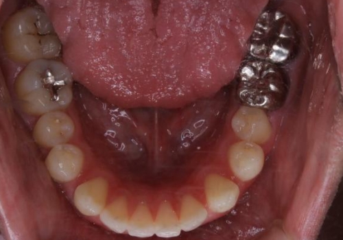 インビザライン・ライトで”すきっ歯と出っ歯”を改善の治療前