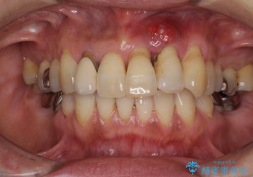 歯茎の再生治療の症例 治療前