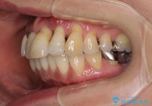 気になる所を一気に治療 総合歯科治療の治療前