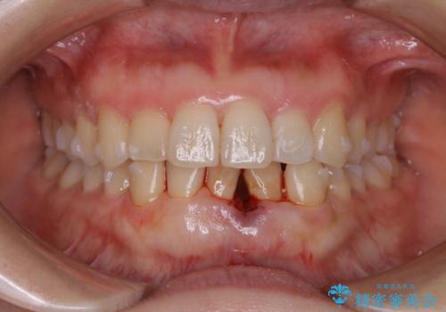 インビザライン・ライトでの抜歯矯正治療 (スリーインサイザー仕上げ)の治療中