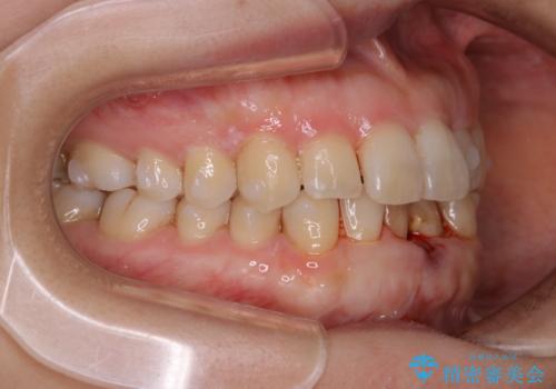 インビザライン・ライトでの抜歯矯正治療 (スリーインサイザー仕上げ)の治療中