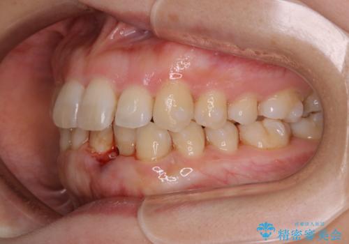 インビザライン・ライトでの抜歯矯正治療 (スリーインサイザー仕上げ)の治療中