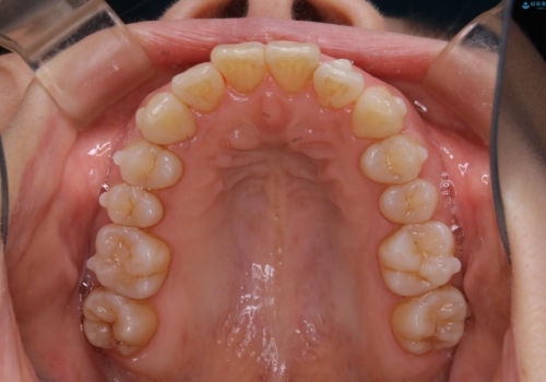 インビザライン・ライトでの抜歯矯正治療 (スリーインサイザー仕上げ)の治療中