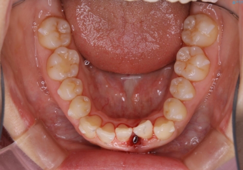 インビザライン・ライトでの抜歯矯正治療 (スリーインサイザー仕上げ)の治療中
