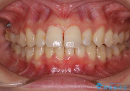 1本だけ着色がついてしまうのを綺麗にの治療前