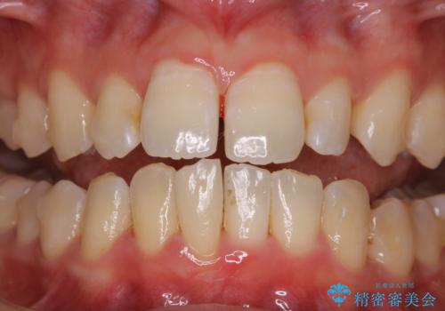 1本だけ着色がついてしまうのを綺麗にの治療前