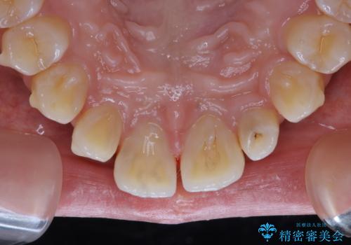 1本だけ着色がついてしまうのを綺麗にの治療前