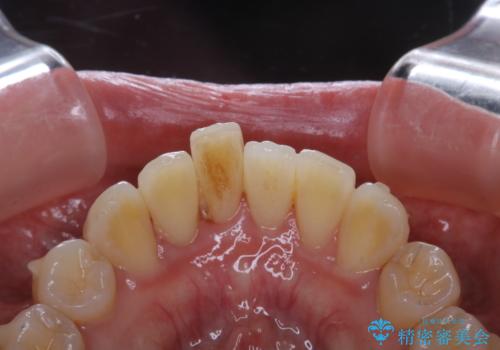 1本だけ着色がついてしまうのを綺麗にの治療前