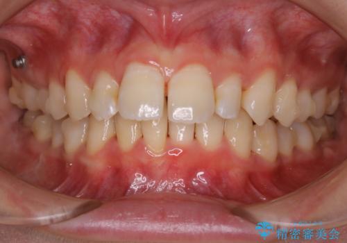 1本だけ着色がついてしまうのを綺麗にの治療後