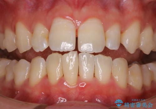 1本だけ着色がついてしまうのを綺麗にの治療後