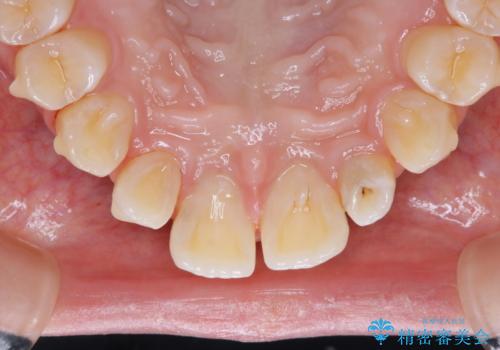1本だけ着色がついてしまうのを綺麗にの治療後