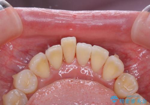 1本だけ着色がついてしまうのを綺麗にの治療後