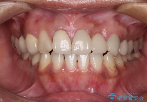 以前治療した歯が続々とむし歯に　全顎むし歯治療の治療後