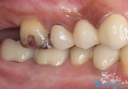 以前治療した歯が続々とむし歯に　全顎むし歯治療の治療後