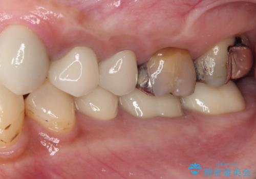 以前治療した歯が続々とむし歯に 全顎むし歯治療の治療後