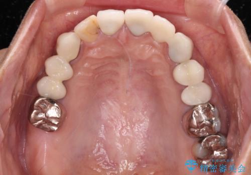 以前治療した歯が続々とむし歯に 全顎むし歯治療の治療後