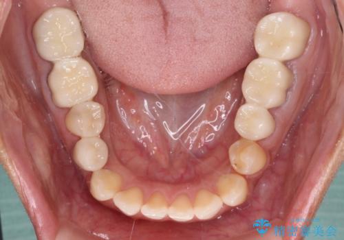 以前治療した歯が続々とむし歯に 全顎むし歯治療の治療後