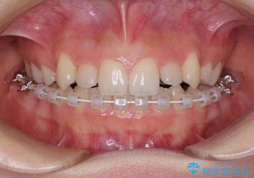 目立つ八重歯を目立たない装置で ハーフリンガルによる抜歯矯正の治療中