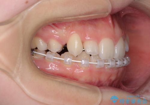 目立つ八重歯を目立たない装置で ハーフリンガルによる抜歯矯正の治療中
