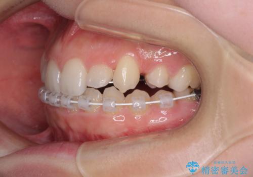 目立つ八重歯を目立たない装置で ハーフリンガルによる抜歯矯正の治療中