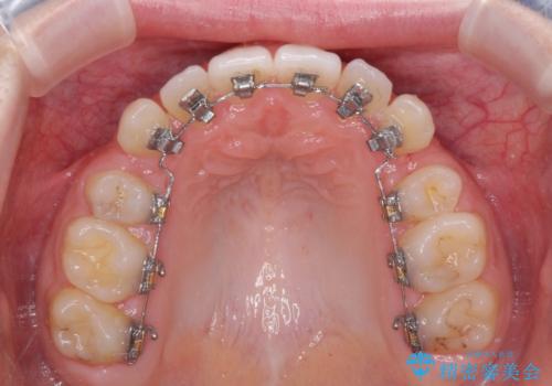 目立つ八重歯を目立たない装置で ハーフリンガルによる抜歯矯正の治療中