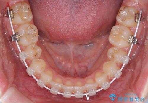 目立つ八重歯を目立たない装置で　ハーフリンガルによる抜歯矯正の治療中