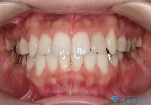 インビザラインで目立たない矯正　ガタガタの歯並びをきれいな歯並びへの症例 治療後