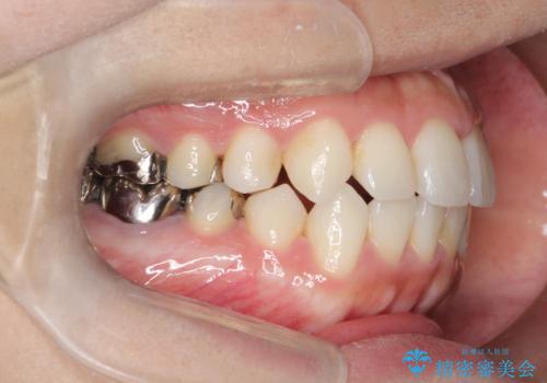 インビザラインで目立たない矯正　ガタガタの歯並びをきれいな歯並びへの治療後