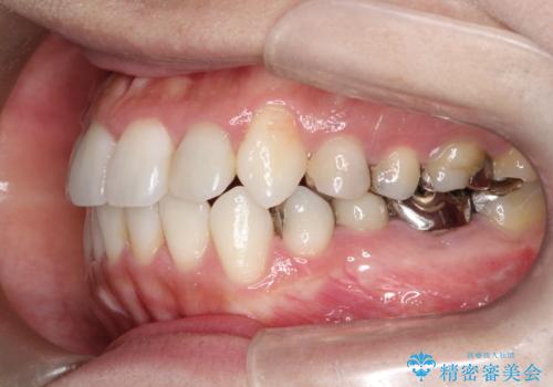 インビザラインで目立たない矯正　ガタガタの歯並びをきれいな歯並びへの治療後