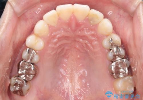 インビザラインで目立たない矯正 ガタガタの歯並びをきれいな歯並びへの治療後