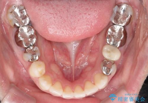 インビザラインで目立たない矯正 ガタガタの歯並びをきれいな歯並びへの治療後