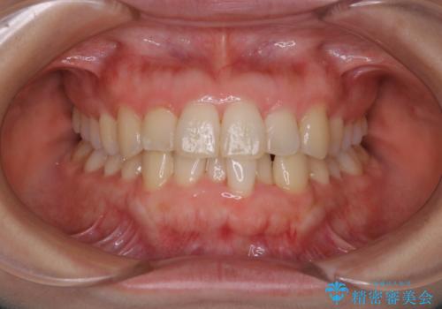 インビザライン・ライトでの抜歯矯正治療 (スリーインサイザー仕上げ)の症例 治療前