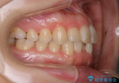 インビザライン・ライトでの抜歯矯正治療 (スリーインサイザー仕上げ)の治療前