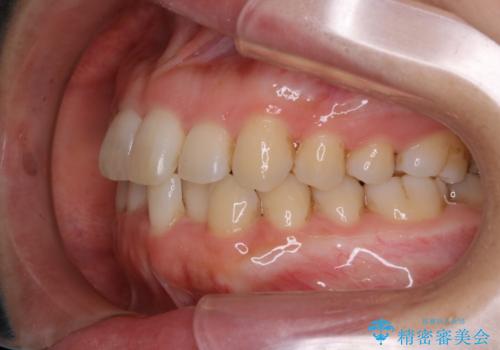 インビザライン・ライトでの抜歯矯正治療 (スリーインサイザー仕上げ)の治療前