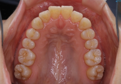 インビザライン・ライトでの抜歯矯正治療 (スリーインサイザー仕上げ)の治療前
