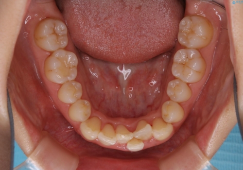インビザライン・ライトでの抜歯矯正治療 (スリーインサイザー仕上げ)の治療前