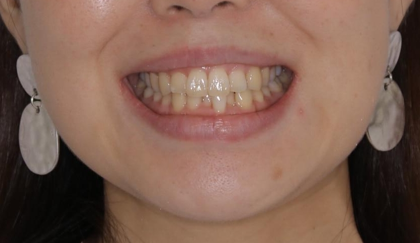インビザライン・ライトでの抜歯矯正治療 (スリーインサイザー仕上げ)の治療前（顔貌）