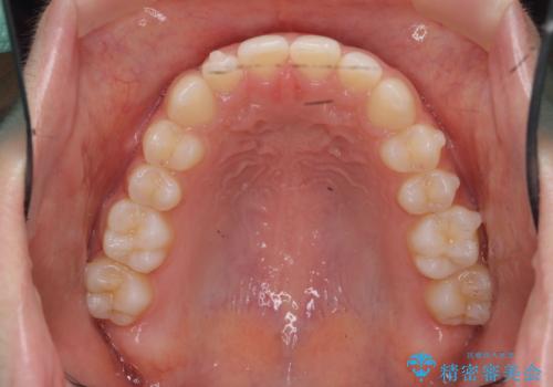 前歯のガタつきを改善　マウスピース矯正とワイヤー部分矯正の治療後