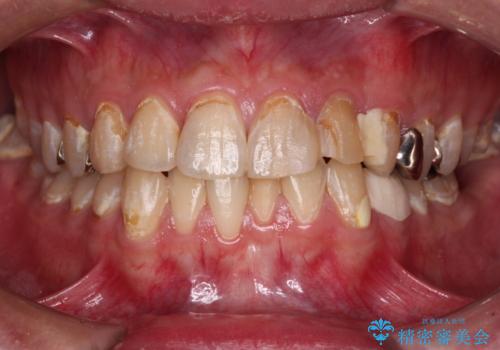 むし歯だらけの前歯をきれいにしたい オールセラミッククラウンによる審美歯科治療の治療前