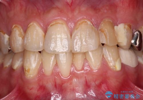 むし歯だらけの前歯をきれいにしたい オールセラミッククラウンによる審美歯科治療の治療前