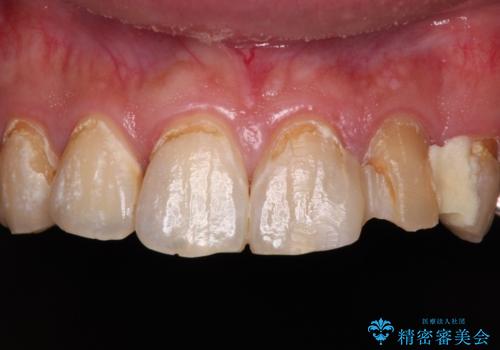 むし歯だらけの前歯をきれいにしたい オールセラミッククラウンによる審美歯科治療の治療前