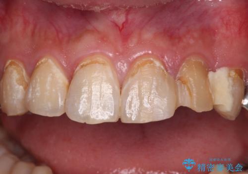 むし歯だらけの前歯をきれいにしたい　オールセラミッククラウンによる審美歯科治療の治療前