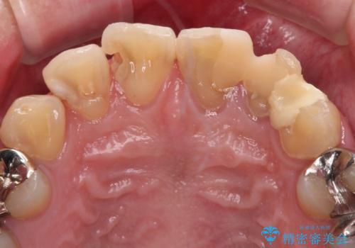 むし歯だらけの前歯をきれいにしたい オールセラミッククラウンによる審美歯科治療の治療前