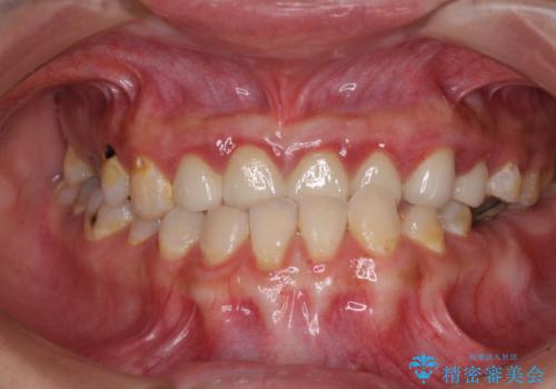 むし歯だらけの奥歯　セラミッククラウンによるむし歯治療の治療前
