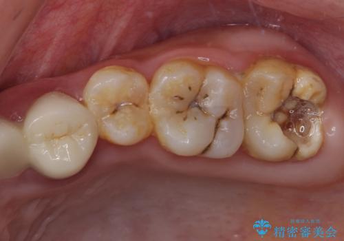 むし歯だらけの奥歯　セラミッククラウンによるむし歯治療の症例 治療前