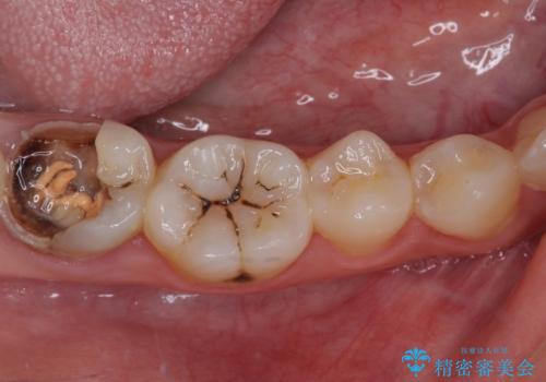 むし歯だらけの奥歯　セラミッククラウンによるむし歯治療の治療前